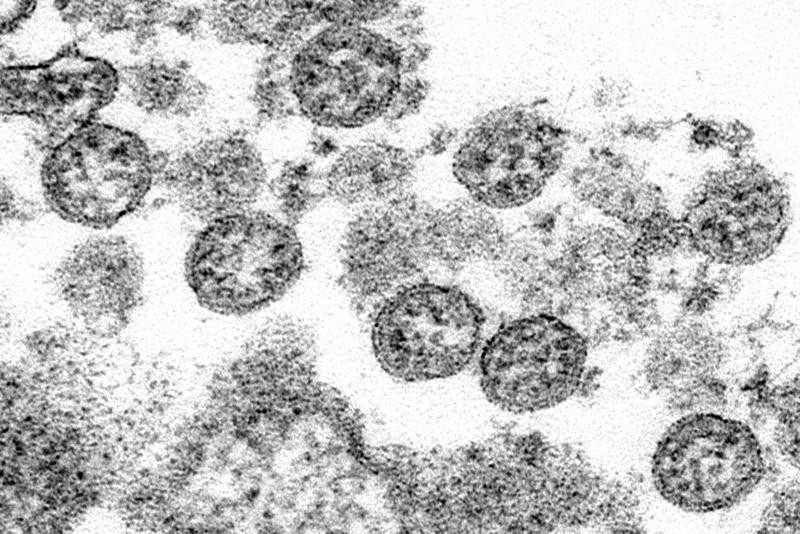 FILE - This 2020 electron microscope image made available by the U.S. Centers for Disease Control and Prevention shows the spherical coronavirus particles from what was believed to be the first U.S. case of COVID-19. A new analysis of blood samples from 24,000 Americans taken early last year is the latest and largest study to suggest that the coronavirus popped up in the U.S. in December 2019 — weeks before cases were first recognized by health officials. (C.S. Goldsmith, A. Tamin/CDC via AP)